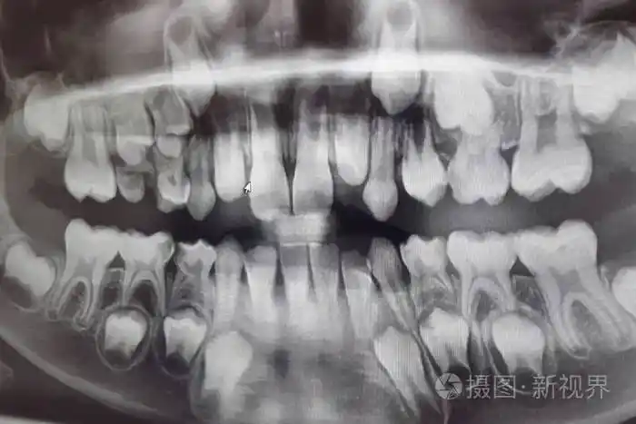 乳制品和新儿童牙齿的x光照片