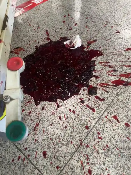 两次大出血,icu住了6天,输了八袋血,到底是什么垃圾医院,垃圾团队,挂