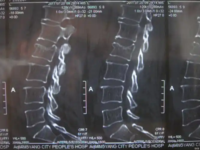 请各位高人看看,这腰椎骨折严重吗?急!