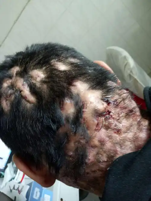 脓肿性穿掘性头部毛囊周围炎