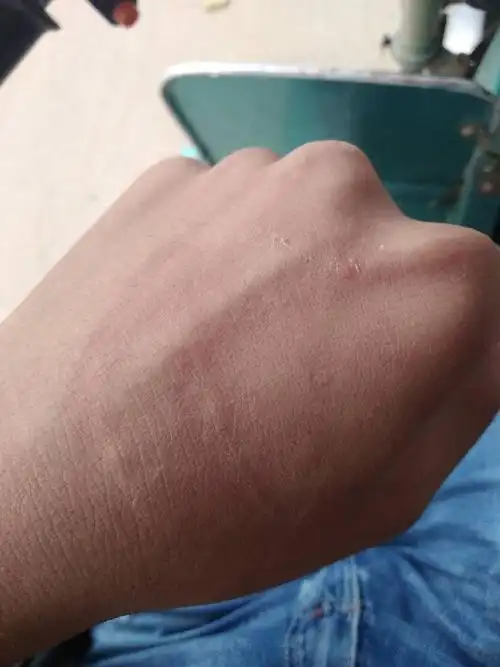 手被老妈用棍子打红,2小时还发发红