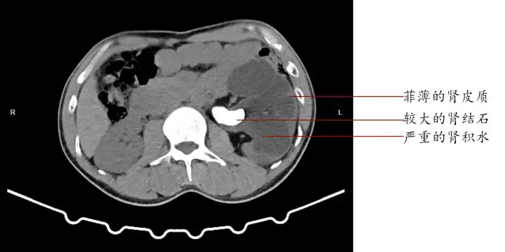 /span> /strong> /p>  p>据不完全统计, /p>  p>我国肾结石发病率为