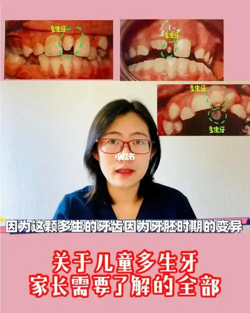 关于儿童多生牙家长需要了解的全部