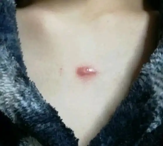 我胸前的疤痕疙瘩很大一块,并且别的地方也开始长了,_圈子-新氧美容