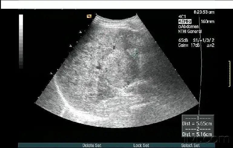 肝ca自发性破裂 - 超声医学讨论版 - 爱爱医医学论坛