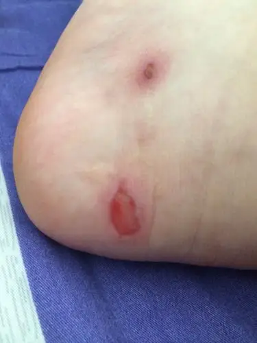 脚前两天穿凉鞋磨破了,这几天上课穿运动鞋,包了创可贴穿的袜子,伤口