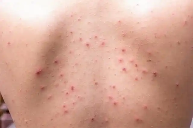 脸上螨虫多?48岁老保姆,偷偷告诉你一个秘诀