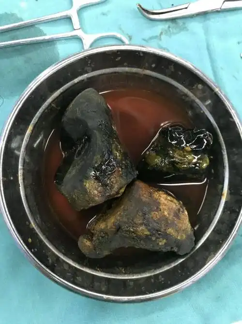 巨大胆管结石,长18cm,粗8cm,很罕见