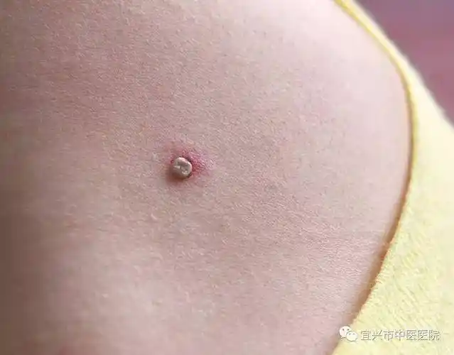 开始她还以为是扁平疣,请家人细看后,发现竟是一只吸饱了血的虫子,半