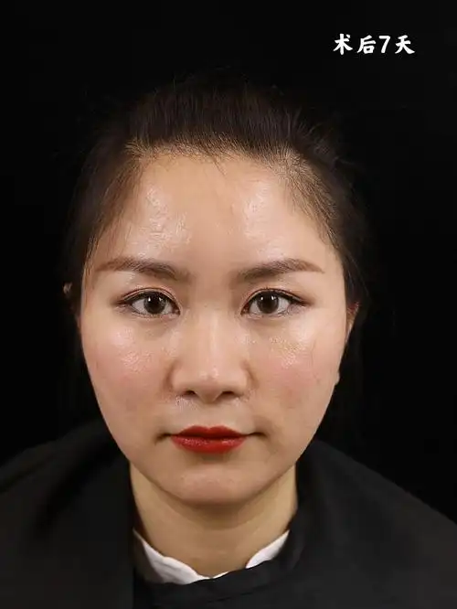 玻尿酸全脸填充,塑造精致饱满脸部!