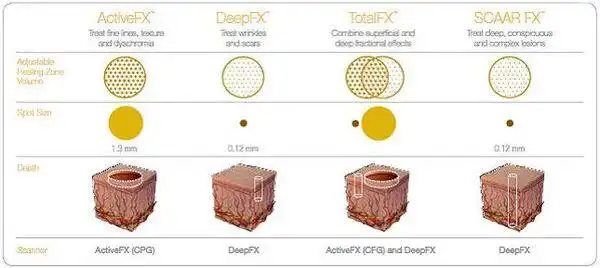 点阵激光fractionallaser的临床应用