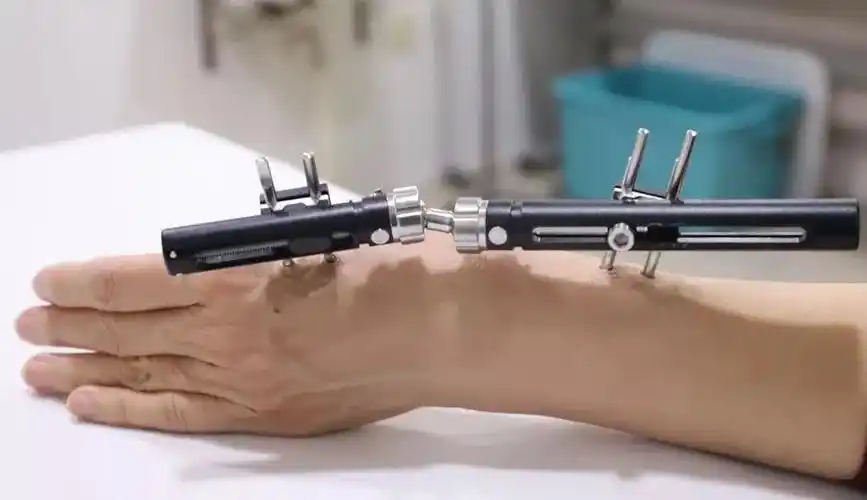 桡骨远端骨折的治疗新选择可调节外固定架