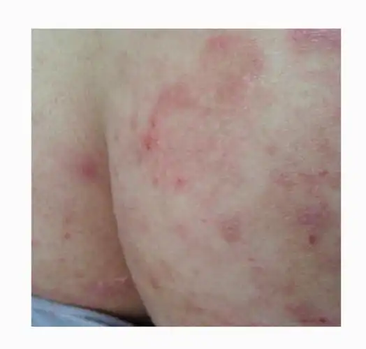 婴儿肛周湿疹图片_有来医生