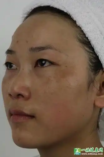 脸上长黄褐斑内调吃什么好