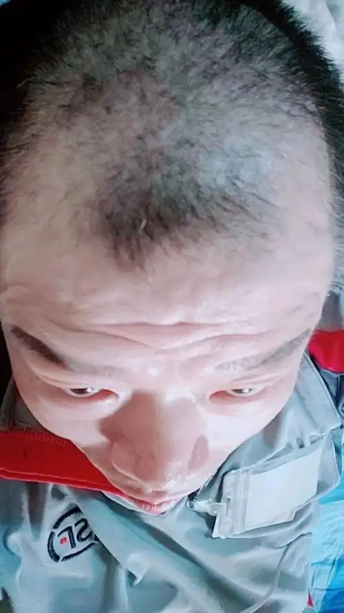 头顶秃成这样了,男人好难,遇到一个贵人帮你,太难