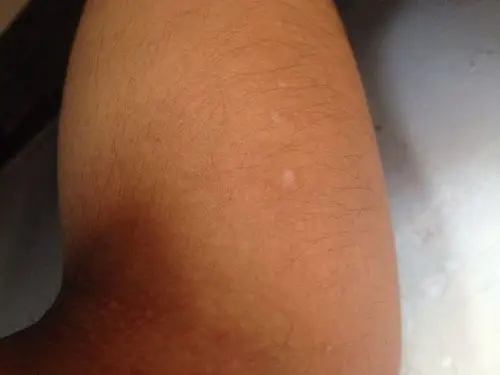 我左右两个胳膊上出现了白斑,不大,这是不是白癜风?