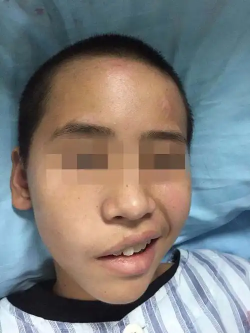 一觉醒来嘴歪了该怎么办