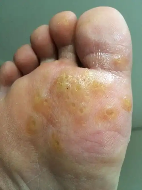 病毒性跖疣图片_有来医生