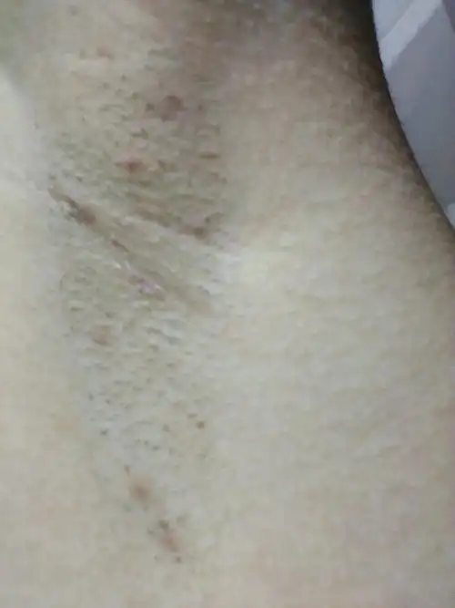 我腋下经常长一下只有在脸上才长的痘痘是怎么回事啊?还经