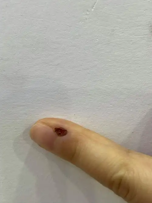 激光去疣第八天