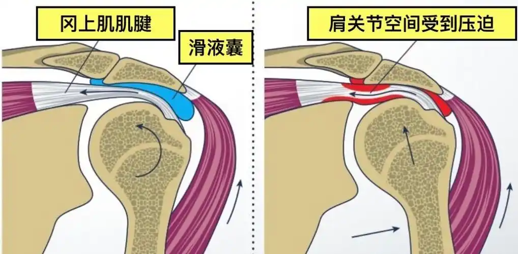 并且在这之间有滑囊来避免活动时肌腱与肩峰之间的直接撞击