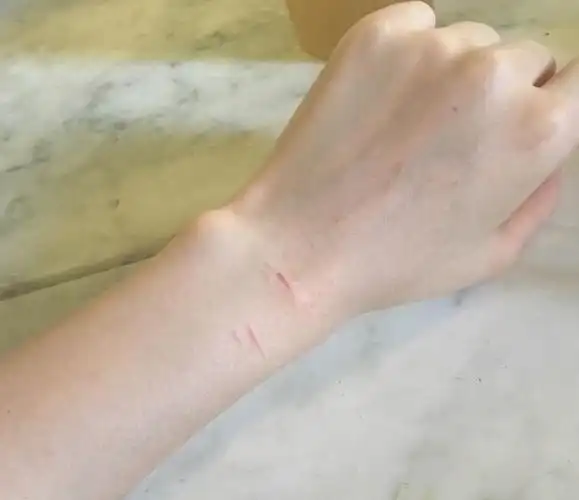 手臂被刀割伤怎么办(手臂被刀割伤怎么防止留疤)