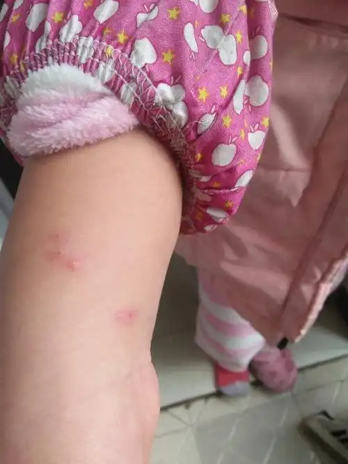 什么?是跳蚤咬吗