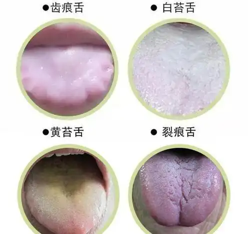 舌苔厚白发黄,体内湿毒的信号,一招教你解决