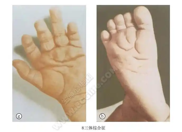8三体综合征