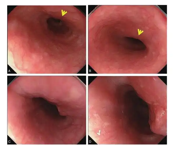 图1-1-2 壁外性压迫部位的观察距门齿35cm食管下段区域.a-b.
