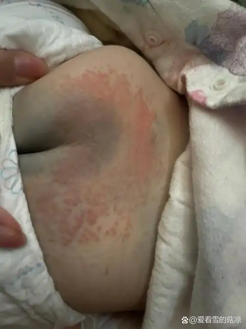 屁股上的湿疹不知道怎么办啦?