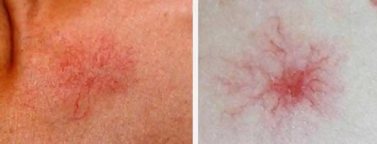 肝癌不痛不痒?但发现已是晚期,多留意5种症状, 就能救你的命!