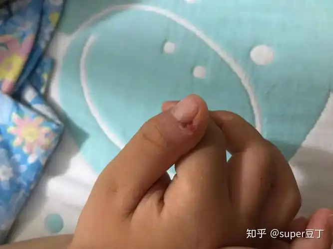 宝贝的甲周疣好了