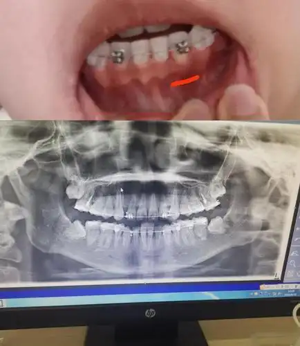 我怀疑那就是我还没有被刮掉的牙槽骨,94赞你的回应回应请先登录