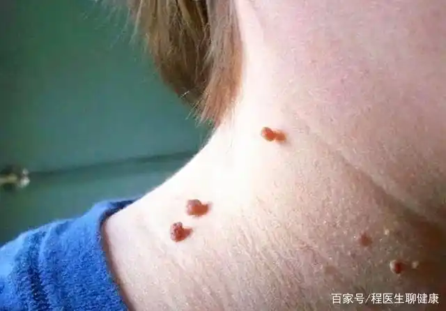 皮肤长"小肉球"是怎么回事,可以抠掉吗?如何处理?