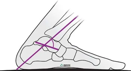 背屈是指胫骨和距骨之间的角度.