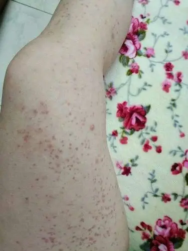 过敏性紫癜是一种由自身免疫反应介导的全身性血管炎