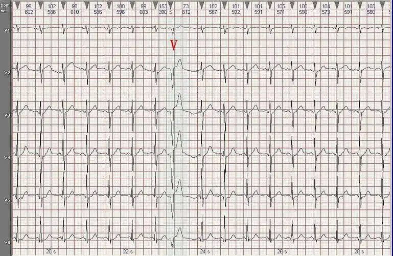 心电图病例分析:前壁肌型室性早搏