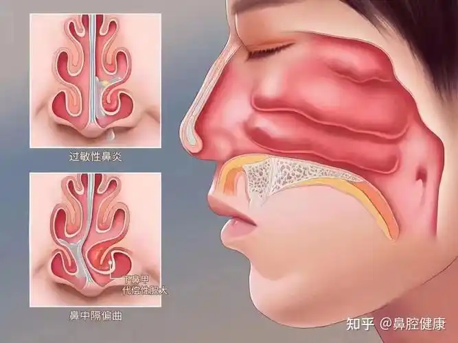 鼻甲肥大的四大危害!