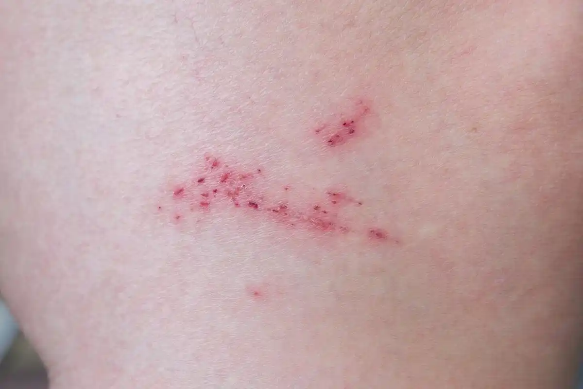 我的右胳膊有一小片血痕,其实原因也很简单,中午我外出的时候,不小心