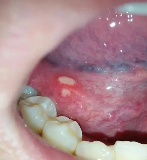 舌头底下,(不是舌头背面)长了两个泡泡,本来很小现在变大了,怎么办 ?