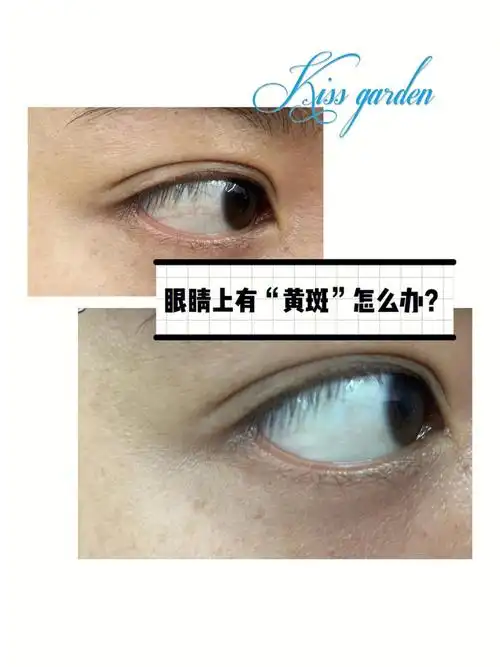 人未老珠先黄眼睛上有黄斑怎么办