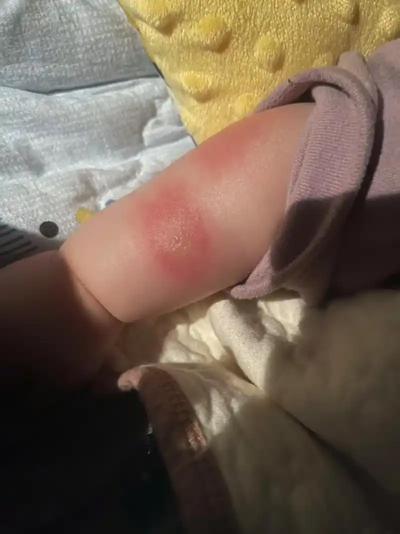 被蚊子咬了就这样了,咋整?咋整? - 抖音