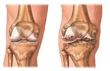 膝盖长了骨刺揉一揉多锻炼能磨掉吗