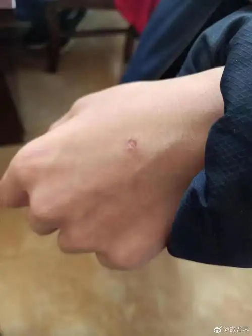 太原一学校4名学生围殴1名同学 持续毒打 手背被烟头烫开坑_高清图集