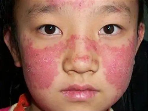患红斑狼疮早期脸部症状图片