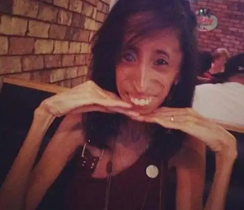 世界上最瘦的人,因减肥患厌食症生不如死(仅重20公斤)__财经头条