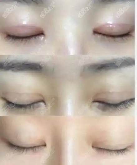 赵瑞庆全切双眼皮恢复过程