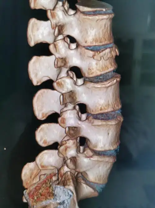 腰2椎体压缩性骨折,闭合复位微创经皮钉棒系统内固定手术治疗.