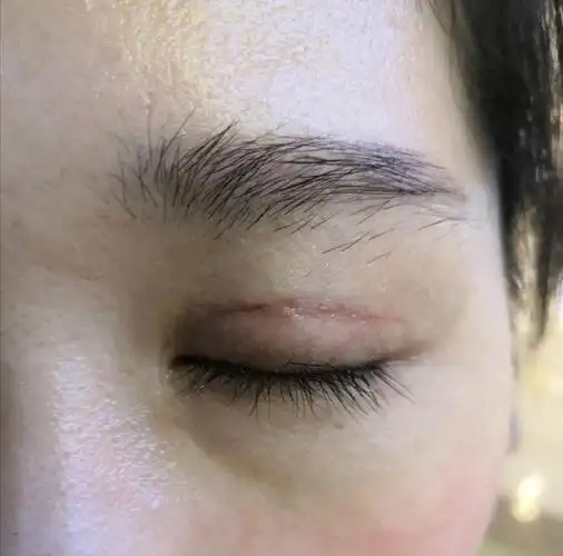 双眼皮